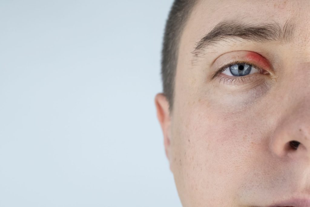 remede-paupieres-gonflees-description